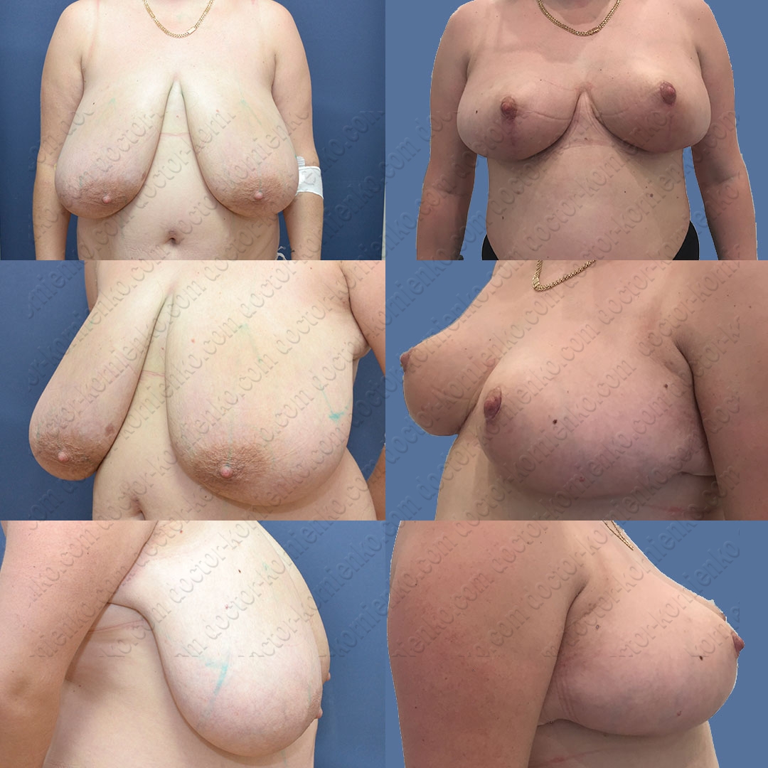 подтяжка груди для женщин фото 17